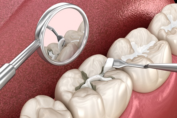 Signs You May Need A Dental Filling