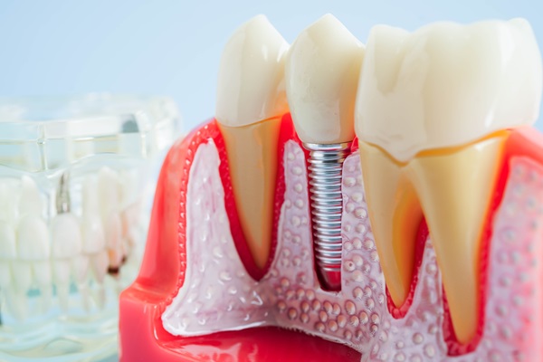How To Properly Care For Dental Implants