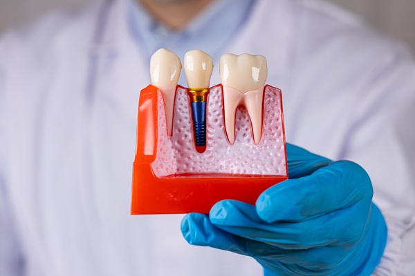 How To Know You Are A Candidate For Dental Implants
