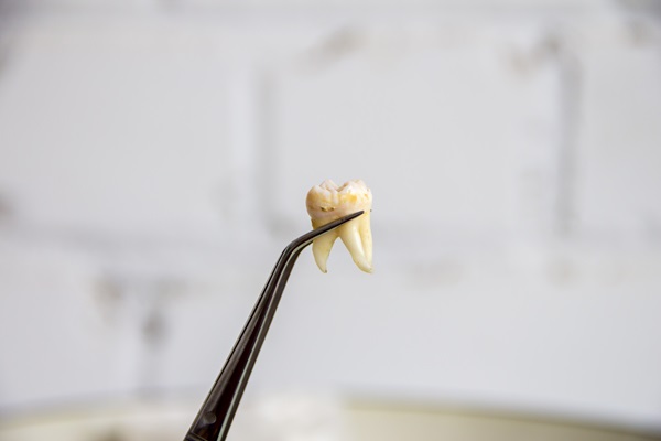 Commonly Asked Questions About Wisdom Tooth Extractions